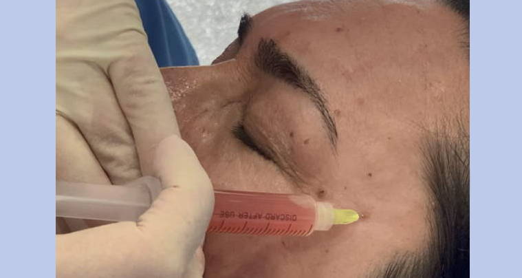 Plasma para tratar rugas